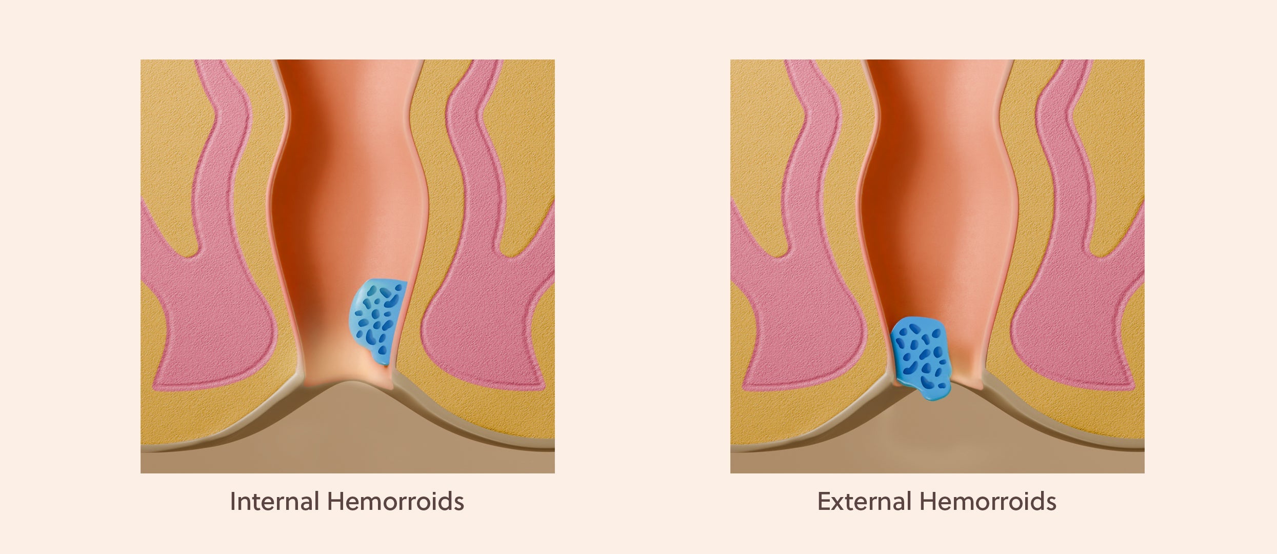 Internal vs. External Hemorrhoids: Differences, Symptoms, and Treatment